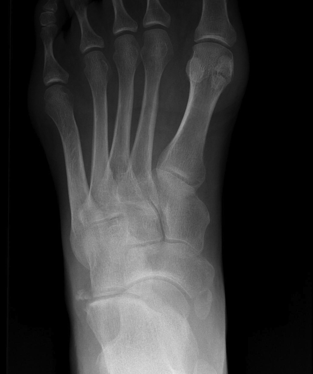 Accessory Navicular